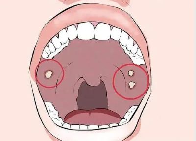 广州中医肿瘤专家:这四种原因会导致口腔癌记得收藏起来