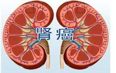 广州中医肿瘤科医师:带你们了解三大肾癌的症状表现,生活中如何预防肾癌