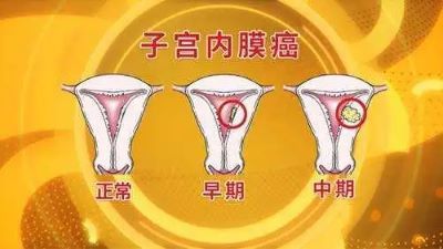 广州治疗子宫内膜癌老中医:什么类型的人比较容易患子宫内膜癌呢