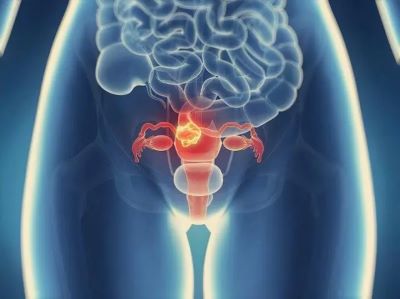广州中医肿瘤专家:这些治疗卵巢癌的方法你知道吗