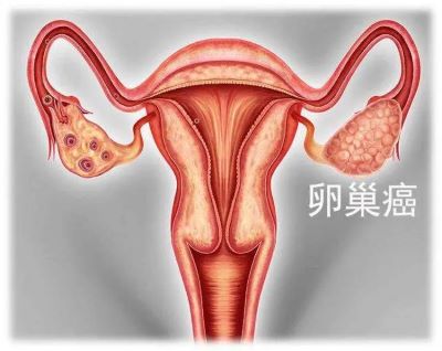 广州治疗卵巢癌中医专家:详细讲解女性卵巢癌的症状和危害