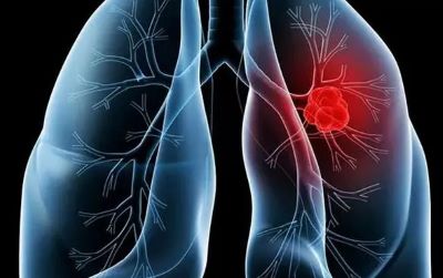 广州中医肿瘤专家:防止肺癌最好的方法是什么