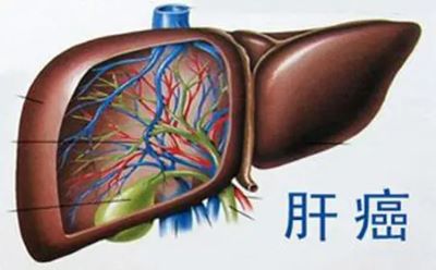 广州中医肿瘤医师排名|这些肝癌的典型早期症状你又知道多少