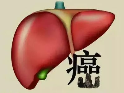 为什么全球一半肝癌患者都是我国人?广州老中医张忠民是这么解释的
