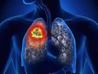 广州中医肿瘤专家张忠民:为什么肺癌晚期难以治疗?术后这些事情不能忘