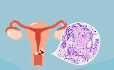 关于卵巢癌中医能不能治好?看完你就明白了