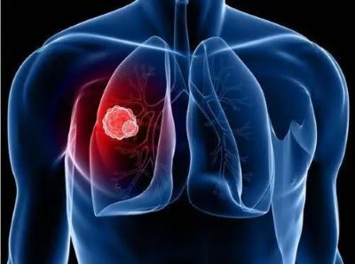 怎么判断肺癌是否会复发?从这四个方面入手就对了
