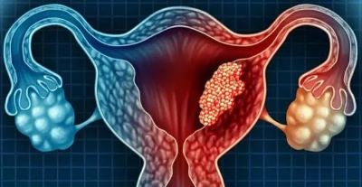 卵巢癌为何被称为妇科杀手?原因无非是这四点！