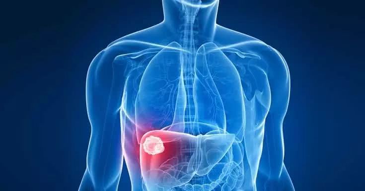 为何出现肝癌  可能是这4个因素