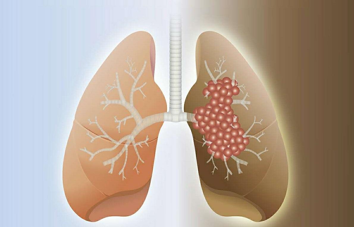 生活中如何预防肺癌的发生？从这2方面入手